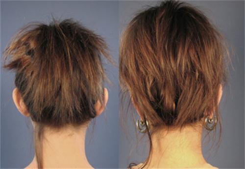 Intervento Otoplastica Dopo