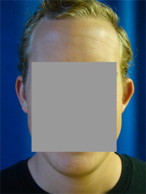 Otoplastica 2 prima