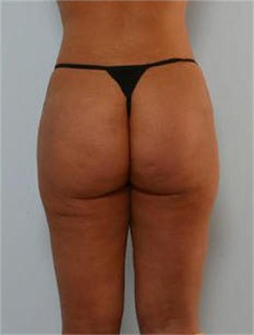 Gluteoplastica 3 dopo
