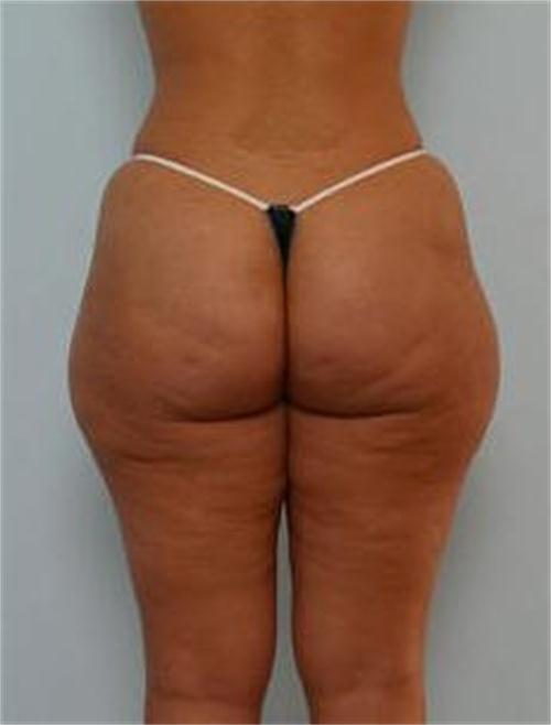 Gluteoplastica 3 prima