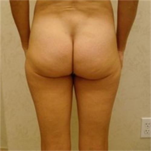 Gluteoplastica 1 prima